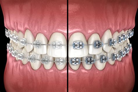 braces clear brackets or metal|difference between aligners and braces.